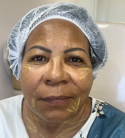 Imagem antes e depois do procedimento Bioestimulador de Colágeno