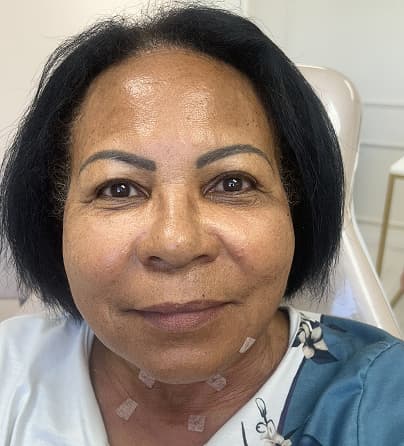 Imagem antes e depois do procedimento Bioestimulador de Colágeno