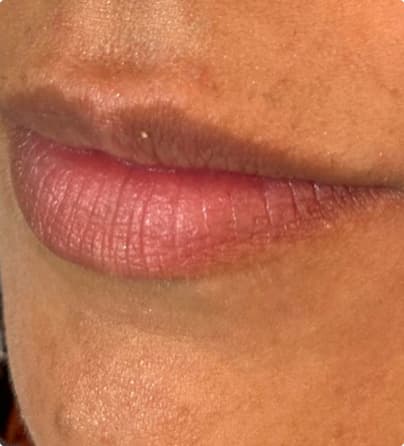 Comparação preenchimento labial