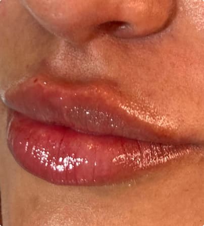 Comparação preenchimento labial