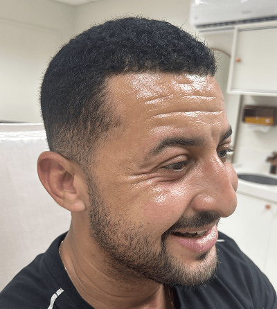 Comparação botox botulínica 1