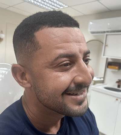 Comparação botox botulínica 1