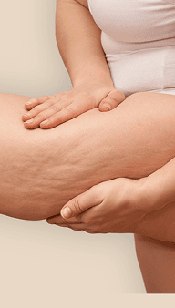 TRATAMENTO PARA CELULITE